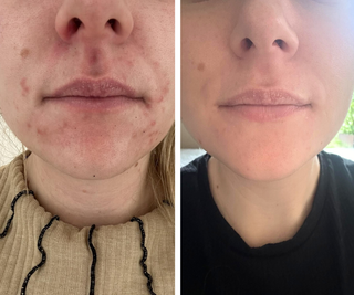 Perioral dermatitis før/efter